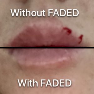 Aesthetic Injections, a patient's recovery with and without FADED. Patient applied FADED only on the bottom lip after lip injections. Overnight the top lip cracked and bled. The top lip healed with FADED. 